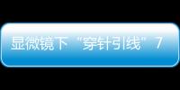 显微镜下“穿针引线”7小时
�！金湾这家医院成功帮患者保住断肢